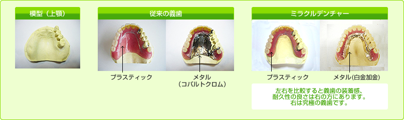 従来の義歯との違い